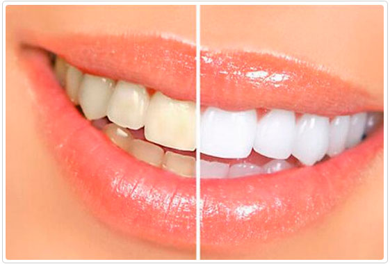 Clareamento Dental em Alphaville, Tamboré e Osasco SP