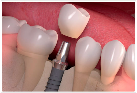 Resultado de imagem para implante dentario